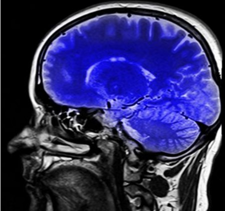 Aneurisma cerebral I Foto: Pxhere/EBC